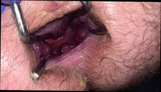 Video 1596354451: gaping prolapsed ass hole, fisting gape prolapse, anal gape prolapse, anal gape compilation, solo anal gaping, solo toying compilation, gay solo compilation, anal sex ass gaping, anal fisting gaping extreme, ass big anal gapes, gaping ass hole stretched, anal gape training, anal gape hd, pleasuring gaping, fucking fisting, super horny