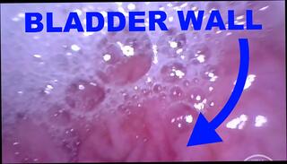 Video 1625899791: pov pumping, pump piss, sissy pumps, sissy gaping hole, fetish pump, amateur shemale pov, amateur hardcore pov, sissy webcam, inside pov, inflation, austrian amateur