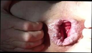 Video 68440001: gaping prolapsed ass, anal gape prolapse, gaping ass toyed, gaping ass pussy, gaping ass gay, gaping arse, gaping man