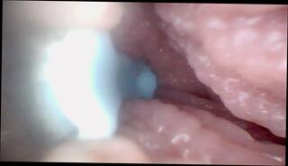 Video 1656207141: prolapsed ass fucked, fetish pussy fucking, fetish couple fucking, fetish sex fuck, pussy speculum, fetish pussy play, big clit fetish, fetish vagina, fetish fantasies fuck, sexual fetish, fetish straight, stretching prolapse, speculum inside, prolapse close, huge prolapse, fetish hd, couple camera sex, pussy deeper, pussies together, takes pussy