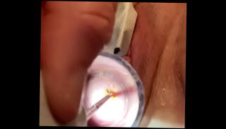Video 1110887935: sadism masochism, fetish penetrating, inserts speculum, medical speculum, speculum extreme, fetish sounding