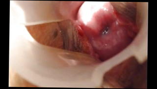 Video 1452818901: inserts speculum, straight cam, long cam