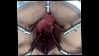 Video 1583440235: bdsm speculum, extreme bdsm anal